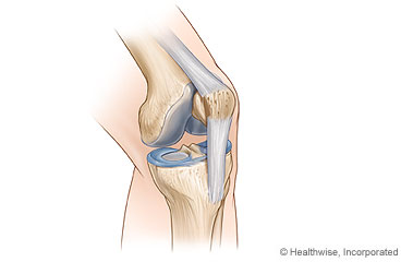 Osgood-Schlatter Disease