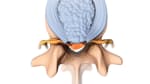 Herniated Disc, Chiropractor, Dr Gary Olson