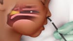 Learning About Your Child's Laryngoscopy