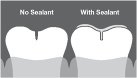 Dental Sealants