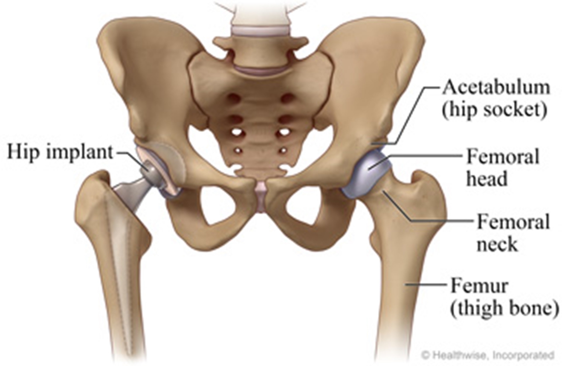 drawing of hip with replacements