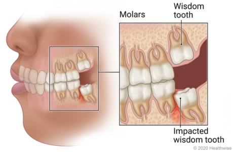 Wisdom teeth