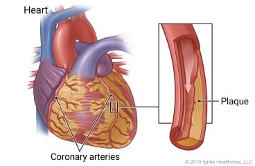 Heart showing two coronary arteries, with detail of artery narrowed by plaque.