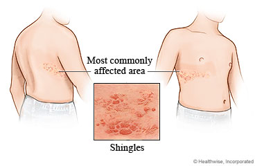 Shingles