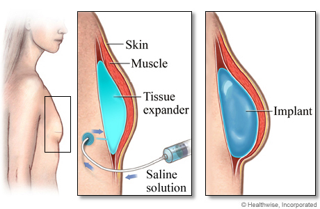 Tissue expander and breast implant after mastectomy.