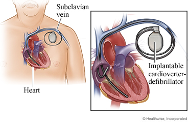 Picture of an ICD with wires going into the heart chambers