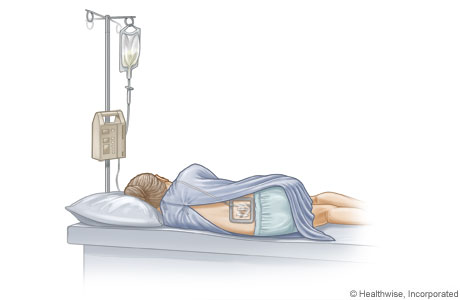 Epidural catheter in place