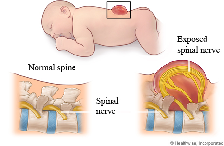 Myelomeningocele (a form of spina bifida).