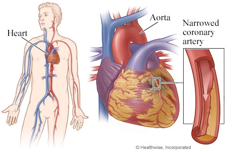 Heart, with detail of coronary artery narrowed by plaque.