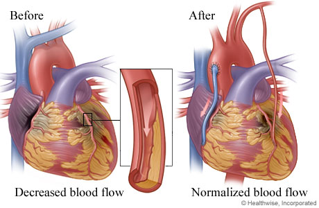 Decreased blood flow caused by narrowed or blocked artery before surgery and improved blood flow after surgery.