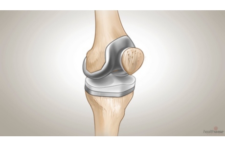 Knee Replacement Surgery