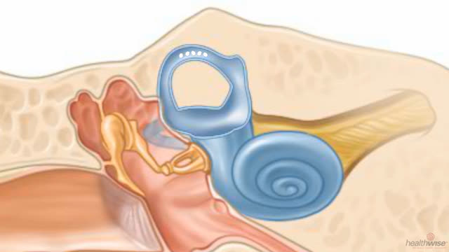 Vertigo: The Epley Maneuver