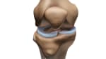 Meniscus Repair: Before Your Surgery