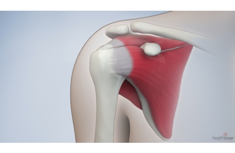 Rotator Cuff Surgery