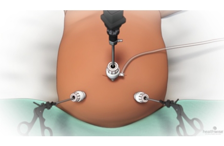 Laparoscopy in Children