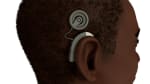 Cochlear Implant: Before Your Surgery