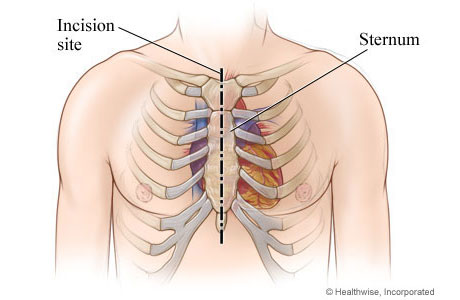Location of incision in chest. Location of incision in chest.