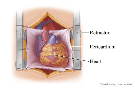 Retractor exposing the heart in the chest. Retractor exposing the heart in the chest.
