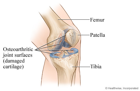 Knee joint with osteoarthritis. Knee joint with osteoarthritis.