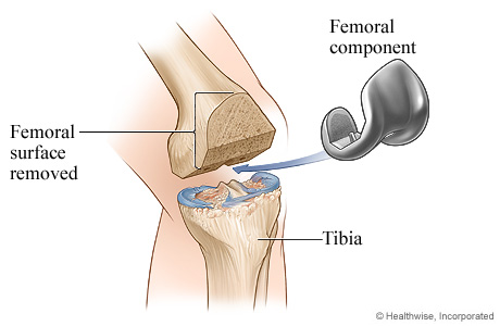 Knee replacement surgery: Femoral component. Knee replacement surgery: Femoral component.