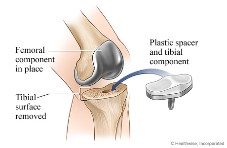 Knee replacement surgery: Tibial component. Knee replacement surgery: Tibial component.