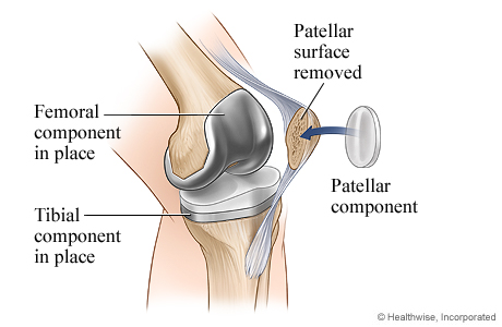 Knee replacement surgery: Patellar component. Knee replacement surgery: Patellar component.