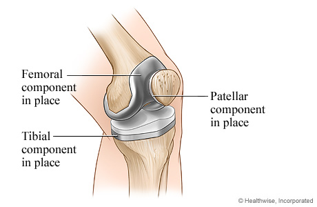 Completed knee replacement surgery. Completed knee replacement surgery.