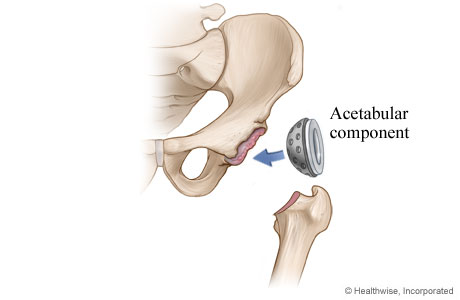 Hip replacement: Hip socket component is placed.