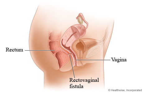 Rectovaginal fistula