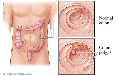 Colon polyps and the location of the colon.