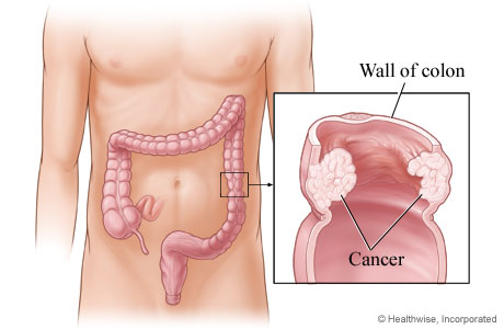 Cancer in the wall of the descending colon Cancer in the wall of the descending colon