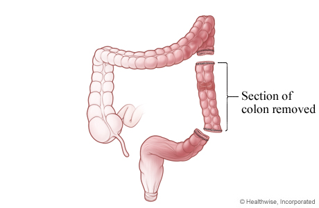 Section of colon removed Section of colon removed