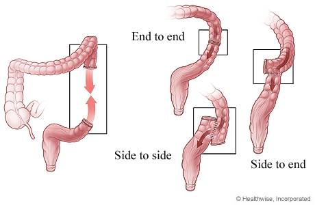 Three ways that colon ends can be reattached after surgery Three ways that colon ends can be reattached after surgery