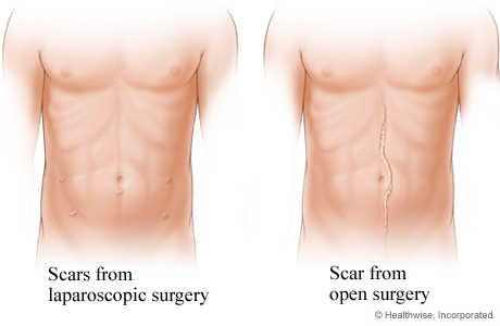 Comparison of laparoscopic surgery scars and open surgery scar Comparison of laparoscopic surgery scars and open surgery scar
