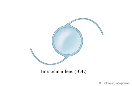 An intraocular lens (IOL). An intraocular lens (IOL).