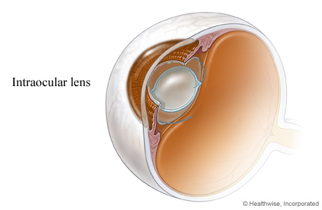 An intraocular lens in place after cataract surgery. An intraocular lens in place after cataract surgery.