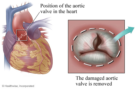 Location of aortic valve in the heart with detail of damaged valve. Location of aortic valve in the heart with detail of damaged valve.