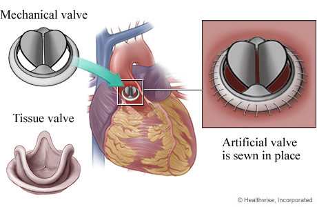 Mechanical valve and tissue valve, showing mechanical valve in heart, with detail of valve sewn in place. Mechanical valve and tissue valve, showing mechanical valve in heart, with detail of valve sewn in place.