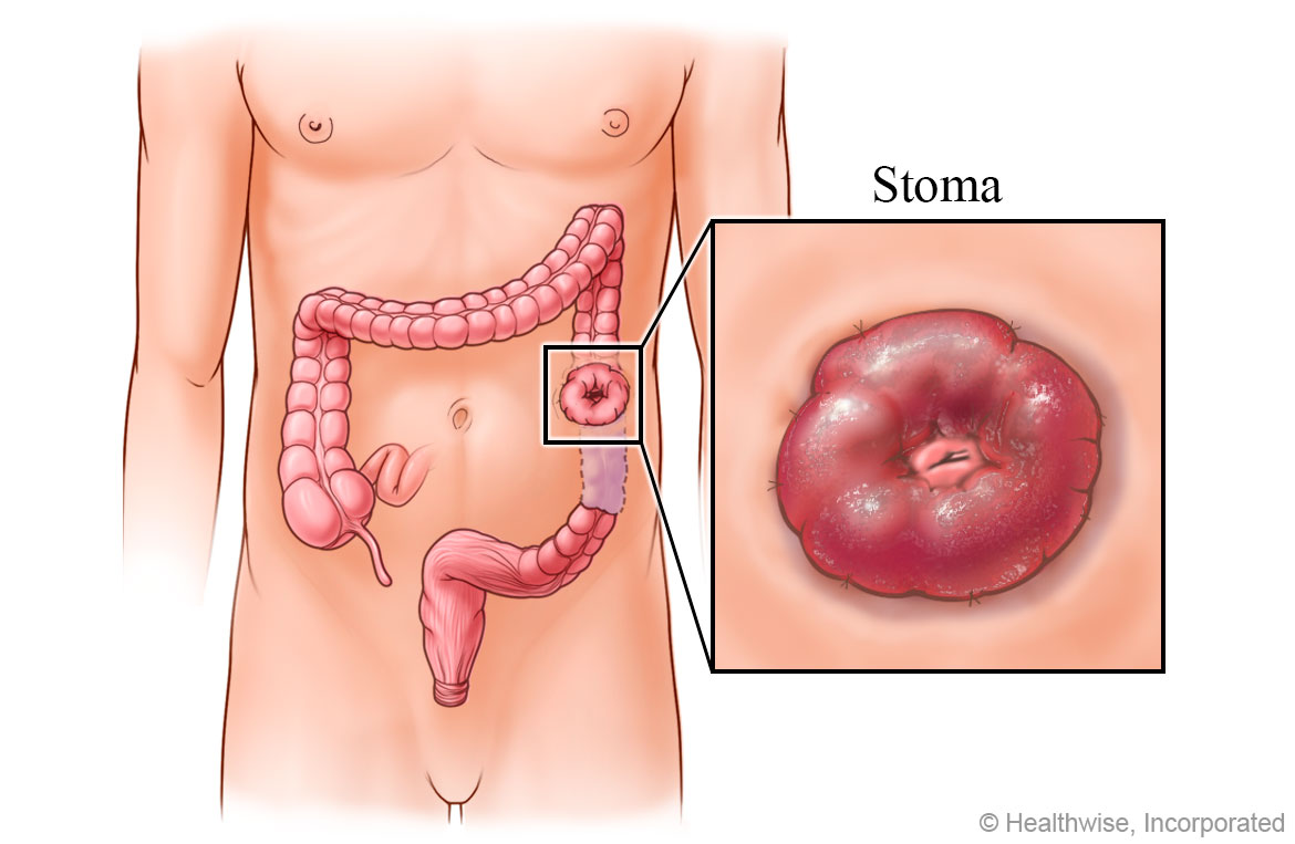 A stoma created after colon surgery A stoma created after colon surgery