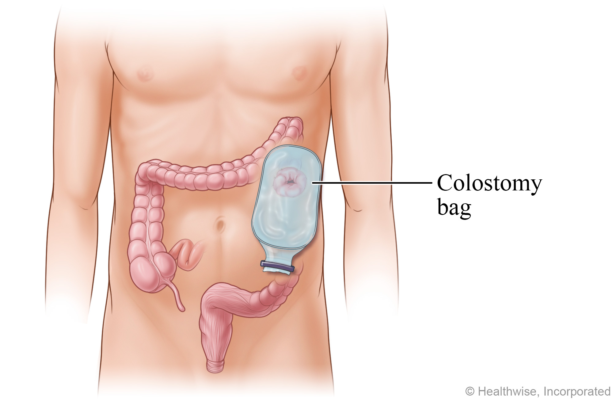 A colostomy bag positioned on the stoma A colostomy bag positioned on the stoma