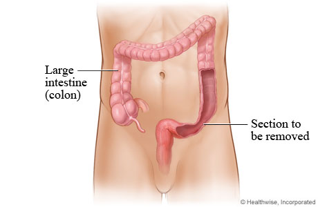 Large intestine (colon) Large intestine (colon)