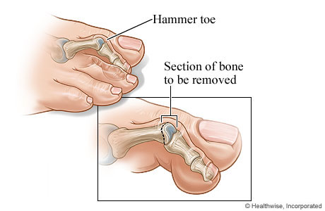 Hammer toe and the section of bone to be removed Hammer toe and the section of bone to be removed
