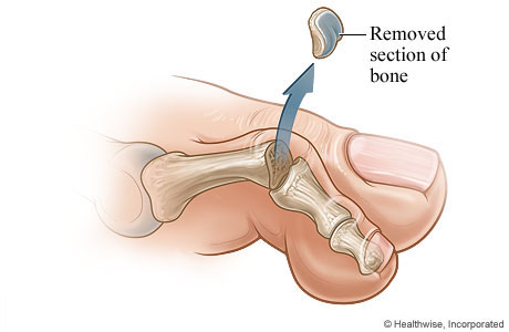The bone section that is removed The bone section that is removed