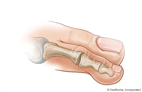 Straightened toe after bone section has been removed Straightened toe after bone section has been removed