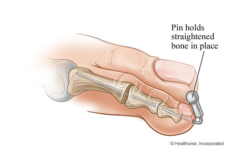 Pin holding the straightened bone in place Pin holding the straightened bone in place