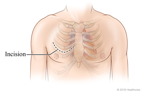 Chest incision site across chest between two ribs. Chest incision site across chest between two ribs.