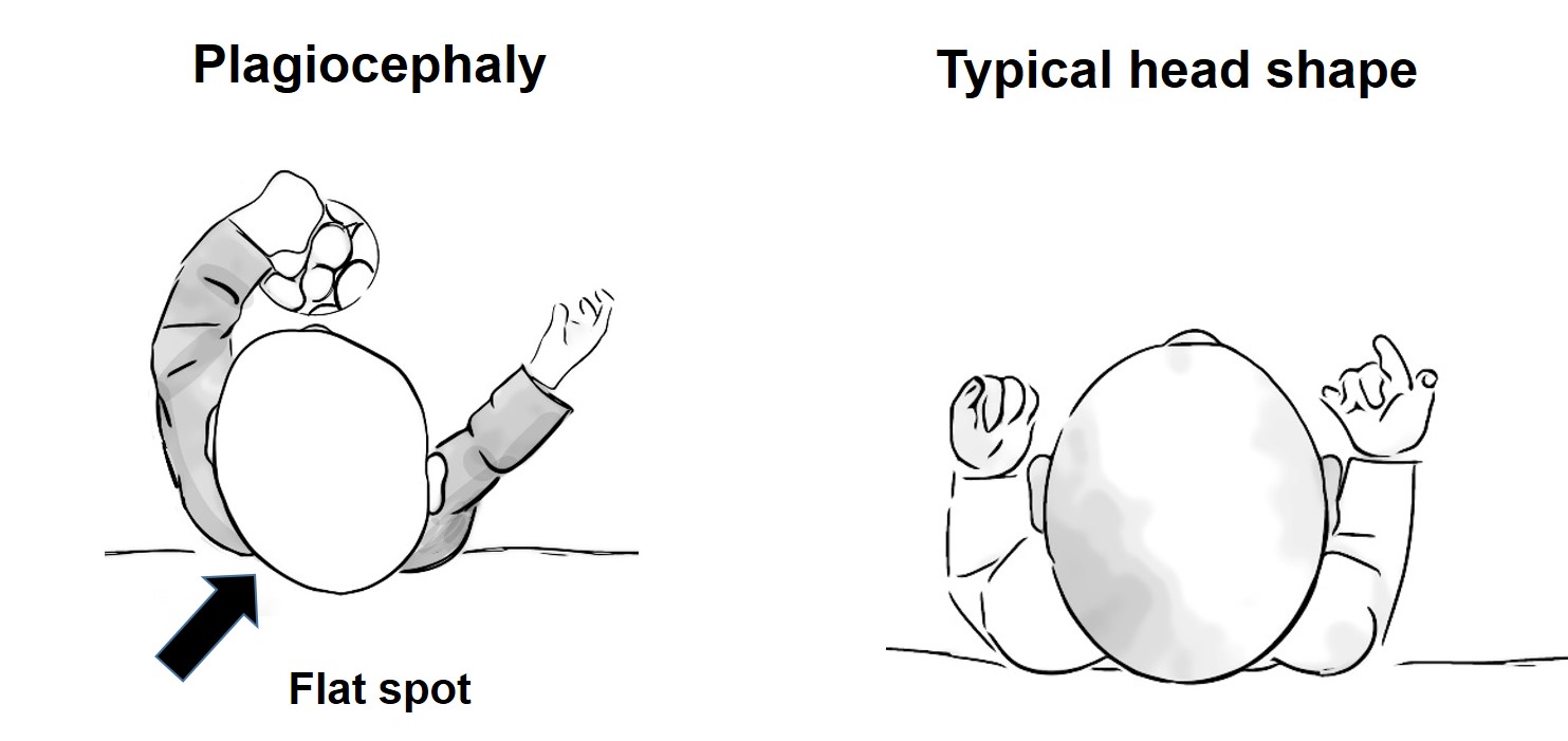 baby with flat spot and baby with typical head shape
