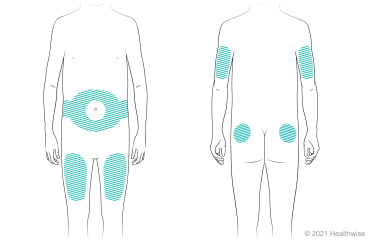 Locations on body for giving insulin shots, including on belly around navel, thighs, back of upper arms, and upper buttocks.