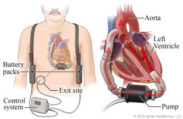 Location of VAD pump, battery packs, and controller, with detail of VAD pumping blood from the heart's left ventricle to the aorta.